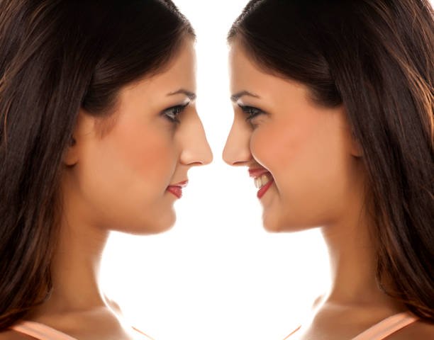 Teenage Nose Augmentation – When is the Right Time?
